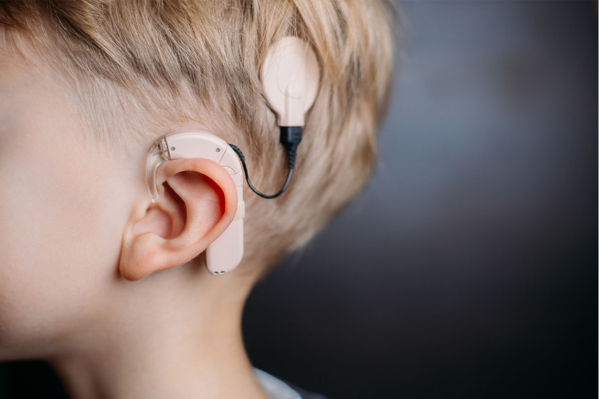 cochlear-implant