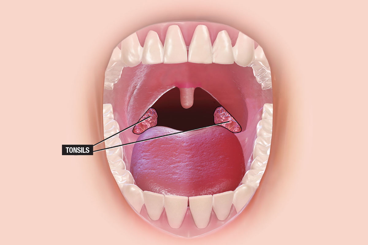 tonsils-adenoids