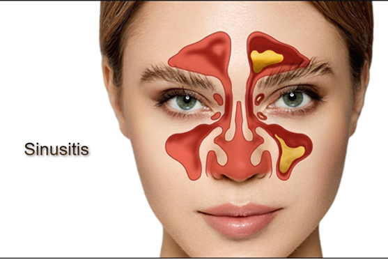 Sinusitis